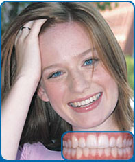จัดฟันใส Invisalign