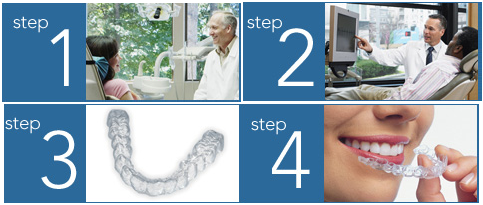 Invisalign_Process Invisalign Process