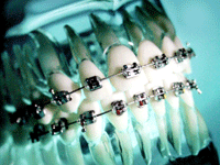Full Metal Braces Full Metal Braces