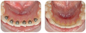 Lingual Orthodontics