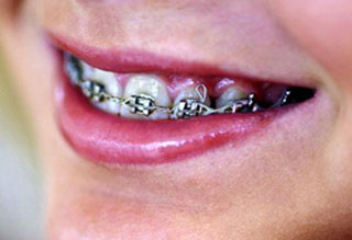 Full Metal Braces Full Metal Braces
