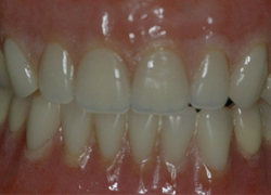Permanent Dentures
