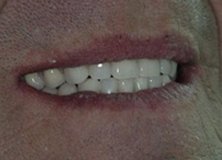 Permanent dentures applyed