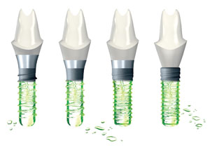 Straumann Implants Straumann Implants