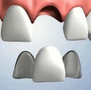 Resin Bonded Bridges