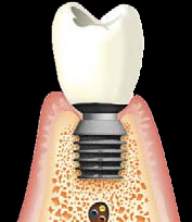 Bicon Implant Bicon Implant