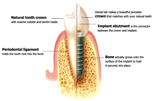รากเทียม Straumann รากเทียม Straumann
