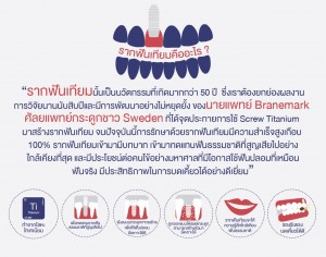 รากฟันเทียมคืออะไร